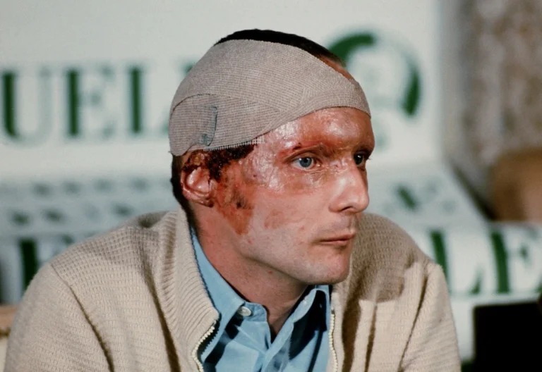 Niki Lauda po havárii v roce 1976